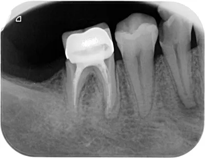 Периодонтит — это воспалительный процесс тканей, которые находятся за  пределами зуба, при котором инфекция проникает из пульповой камеры в  периодонт. | SMAGA dental clinic