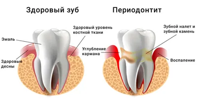 Лечение периодонтита - Стоматологическая клиника в москве - «Интерстом»