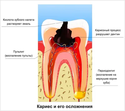 Лечение периодонтита зуба в Краснодаре