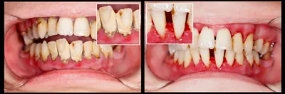 Гранулематозный периодонтит | Симптомы, лечение, профилактика | Клиника  семейной стоматологии Дока-Дент