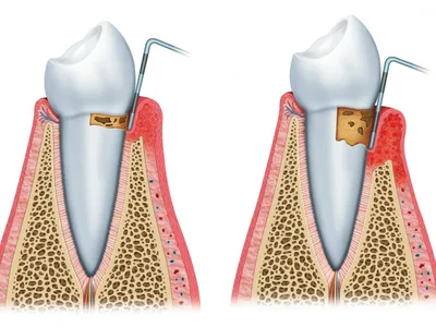 Периодонтит: что это такое, этапы лечения, фото