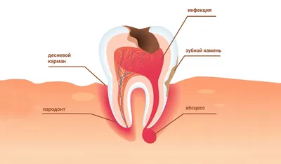 Периодонтит зуба — симптомы, виды, причины возникновения | Как лечить  периодонтит?