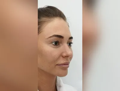 Три месяца после операции по акции Периорбитопластика доктор Козулин Игорь  Дмитриевич. - Блог проекта OMORFIA