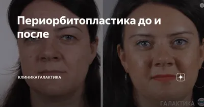 Эндоскопическая периорбитопластика - ЭдМед