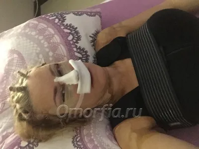 nataly.zelenkova - #периорбитопластика - новое слово в пластической  хирургии век. Периорбитопластика объединяет в себе несколько операций,  обычно это блефаропластика, височный лифтинг, липофилинг. В данном случае  выполнена блефаропластика верхняя и ...
