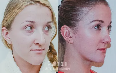 Пластическая хирургия - просто и понятно | Блефаропластика,  периорбитопластика | Дзен