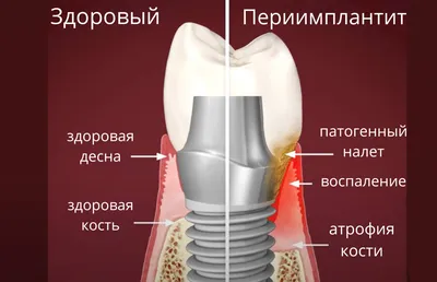 Иссечение уздечки верхней губы лазером в Самаре