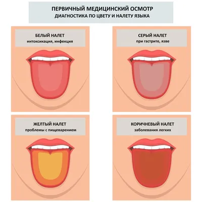 Причины коричневого налета на языке | Диагности и лечение налета