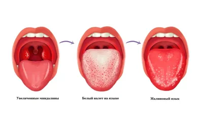 Врач-стоматолог рассказала – почему у ребенка меняется цвет языка,  образуются пятна и язвочки | О детском здоровье: с врачебного на  родительский | Дзен