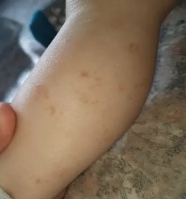 Гфмд: вирусный вирус красного пятна на коленях эпидемическая нога с больной  красной сыпью Стоковое Изображение - изображение насчитывающей зудяще,  микстура: 276316085