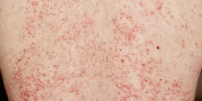 Сухие пятна на коже: три распространенные дерматологические болезни