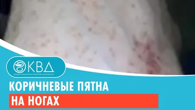 Ответы Mail.ru: Как вылечить белые пятна на ногах? Не нашла признаки, 25лет.