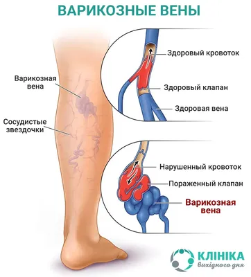 Синие ноги (цианоз) | Флебологический центр Соломахина А.Е