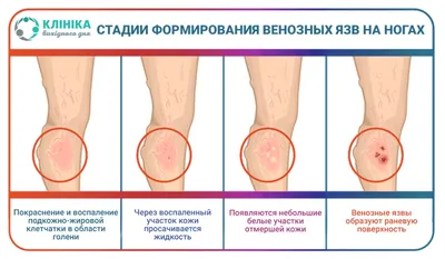 Гель для наружного применения Sopharma Троксерутин Врамед - «Отличная  замена «Венолайфу» » | отзывы