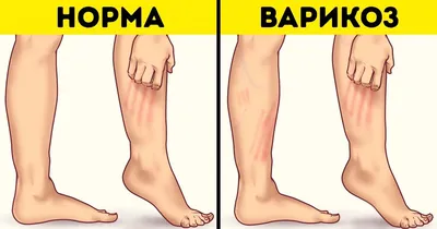 Варикоз: истории из жизни, советы, новости, юмор и картинки — Все посты,  страница 2 | Пикабу