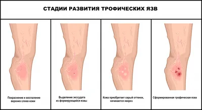 Варикоз: причины, осложнения, лечение — Про Паллиатив