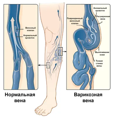 Что будет, если не лечить варикоз? Осложнения варикозного расширения вен