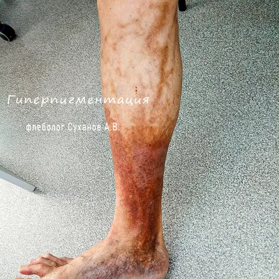 Пигментация кожи на ногах фото фотографии