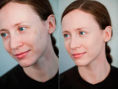 Пигментные пятна на лице: как их убрать, причины появления и методы лечения