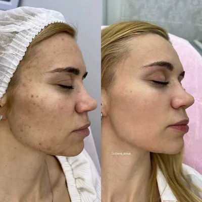 Урок макияжа: как замаскировать на лице пигментное пятно? | Beauty Insider