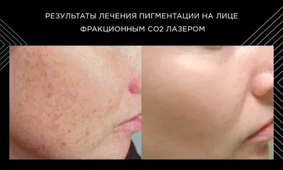 Пигментация на лице | Косметологические аппараты