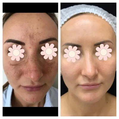 Как удалить пигментные пятна на лице? | Ответы на популярные вопросы от  клиники эстетической медицины и косметологии Premium Aesthetics