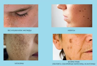 Как убрать пигментные пятна на лице - Арина Киреева - врач-косметолог
