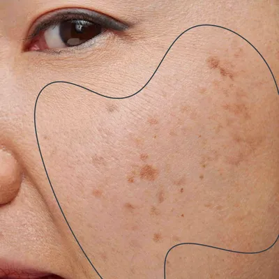 Как убрать пигментные пятна на лице и теле: способы избавиться от  гиперпигментации дома и процедуры у косметолога