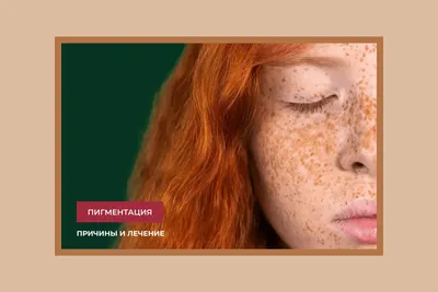 Урок макияжа: как замаскировать на лице пигментное пятно? | Beauty Insider