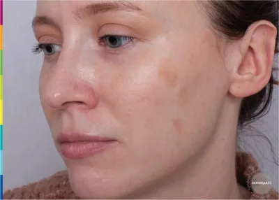 Лечение пигментных пятен на коже лица: эффективное удаление лазером в  Томске | Томск «Доктор Борменталь»