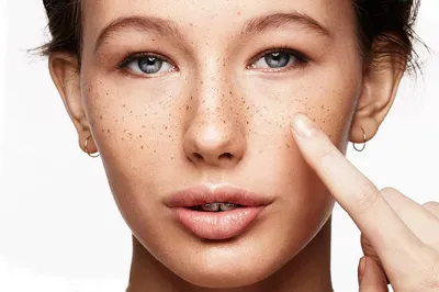Пигментация на лице: личный опыт, фото и комментарий врача | Beauty Insider