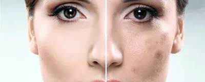 Удаление пигментных пятен на лице в Киеве | Diamond Laser