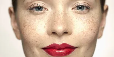 Как убрать пигментацию на лице? Удаление пигментных пятен на лице  аппаратными методами