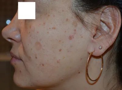 Урок макияжа: как замаскировать на лице пигментное пятно? | Beauty Insider