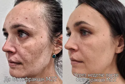 Как избавиться от пигментных пятен на лице и теле