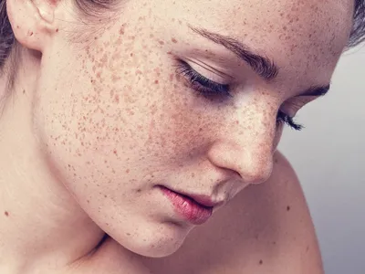 ᐉ Лазерное удаление пигментных пятен ✔️ Убрать пигментные пятна на лице |  Косметологическая клиника EDIT | Косметологическая клиника EDIT