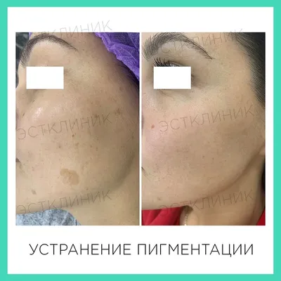 Отбеливающий крем Ален Мак Ахромин с UV-фильтрами - «отличный отбеливающий  крем для лица после беременности » | отзывы