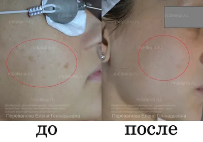 Удаление пигментных пятен лазером в Санкт-Петербурге от 2500 руб.