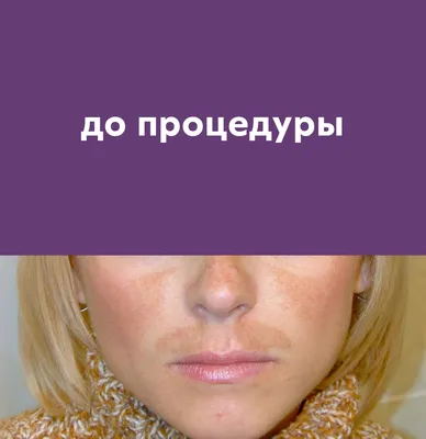 Мелазма: Почему на лице появляются пигментные пятна — Wonderzine