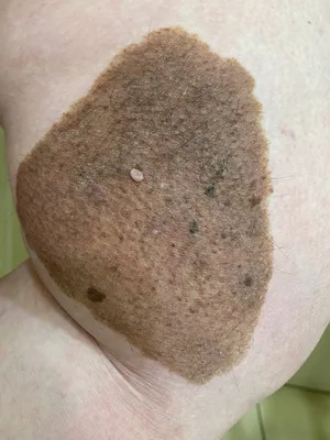 Melanoma Unit on Instagram: \"Внутридермальный невус (он же бородавчатый, он  же папилломатозный) - врожденный или приобретенный доброкачественный пигментный  невус, невусные клетки которого расположены в дерме. Такое образование чаще  всего подвергается ...