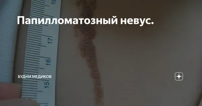 Диспластический невус