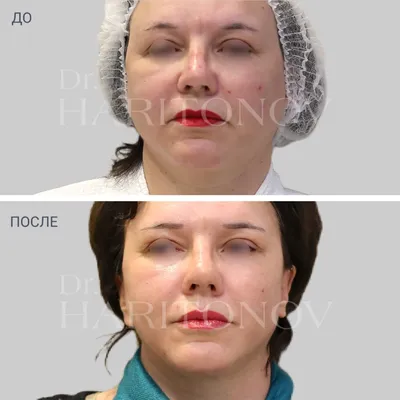 Фото до и после пластических операций | Хирург Сергей Аркадьевич