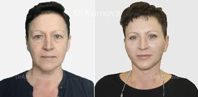 SMAS-лифтинг – фото до и после, результаты СМАС-подтяжки лица | Пластический  хирург Азимова Рано