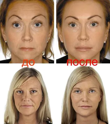 Контурная пластика лица препаратами гиалуроновой кислоты: фото до и после  курса лечения