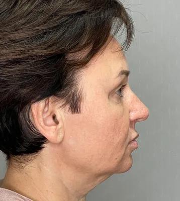 Пластические операции на лице - фото до и после в СМ-Клиника
