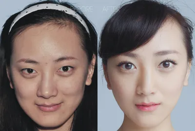 Китаянки до и после пластики | WOMAN