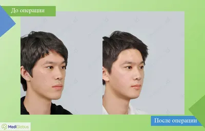 Фото до и после пластики лица, результаты работ | Баланс Здоровья
