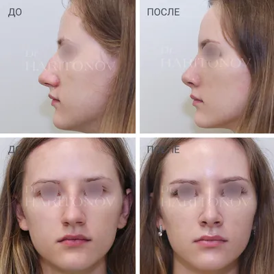 Пластика лица и шеи → Фото результатов до и после пластической операции