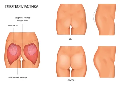 Глютеопластика - увеличение ягодиц имплантами, цена операции в СПб
