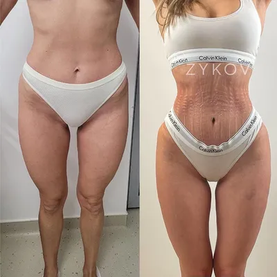 Фото до и после увеличения ягодиц имплантами и жиром | Доктор Зыков